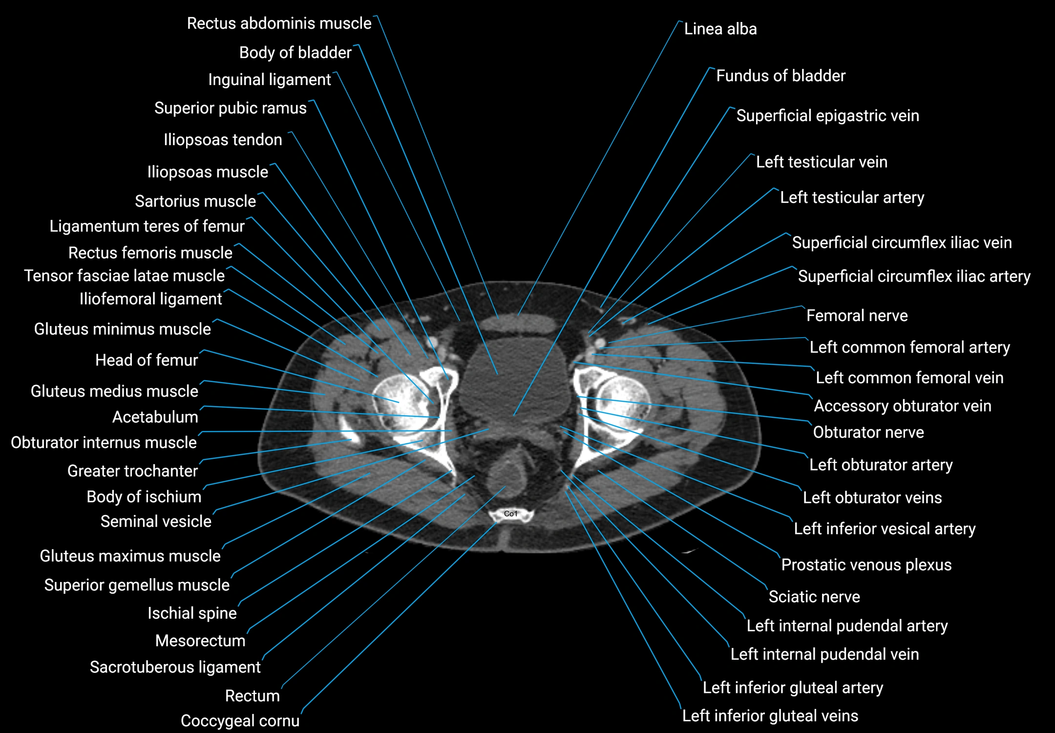 CT male pelvis axial cross sectional anatomy labelled radiology image -00185.webp